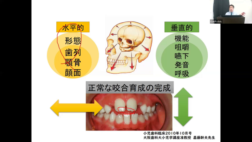 咬み合わせ臨床講座 子どもの歯列成長を助ける小児矯正・MFTセミナー【第3回】ポカン
